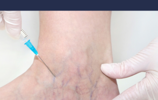 Before & After Spider Vein Treatment 5 spider veins
