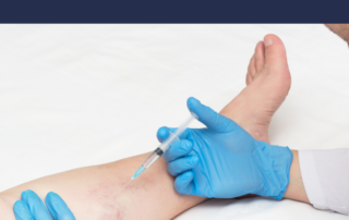 sclerotherapy