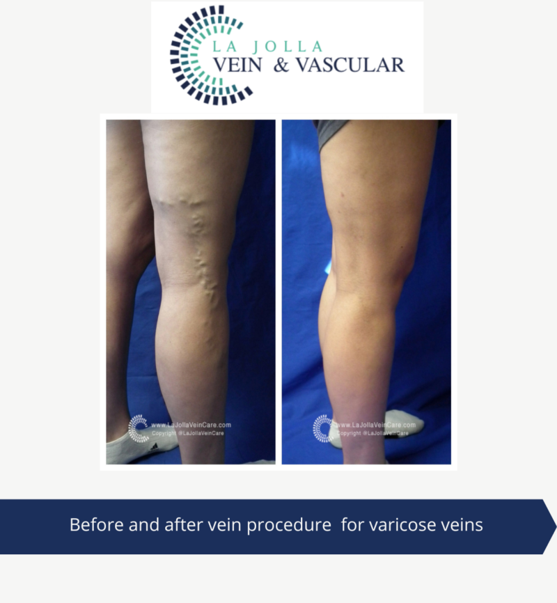 Vein & Vascular Treatment | Vein and Vascular Care Clinic | La Jolla, CA