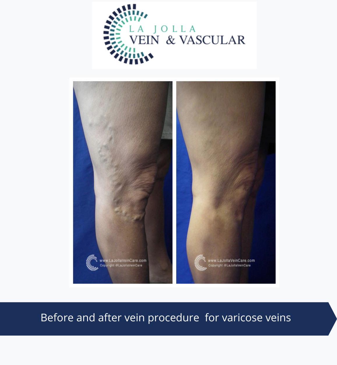 Vein And Vascular Treatment Vein And Vascular Care Clinic La Jolla Ca 