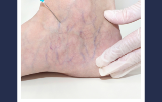 sclerotherapy