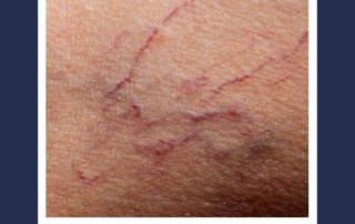spider veins