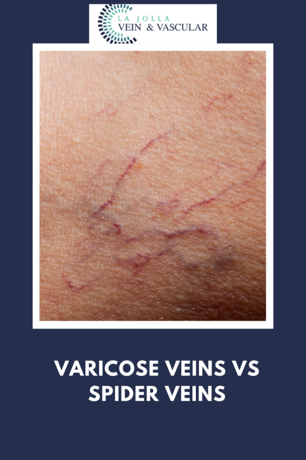 Vein And Vascular Treatment Vein And Vascular Care Clinic La Jolla Ca 3596