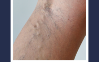 vein valves