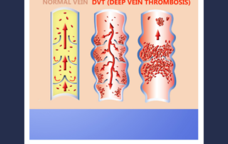 dvt
