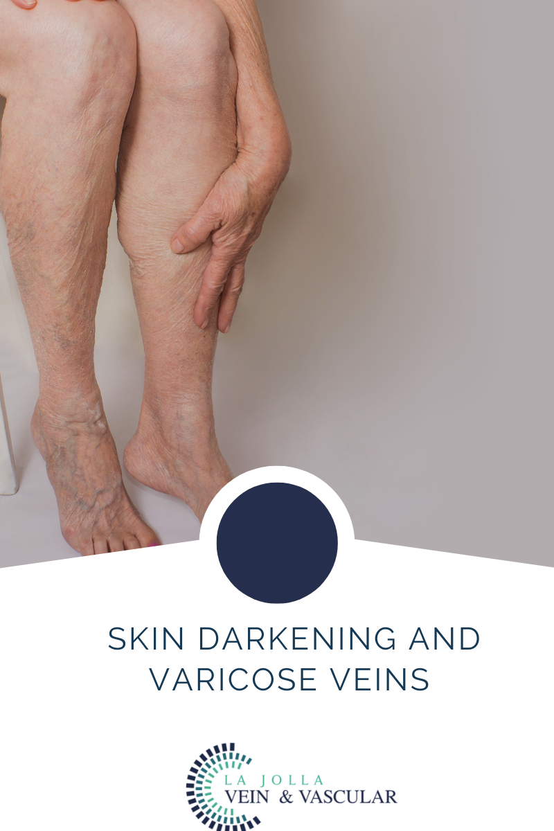 Can Varicose Veins Cause Skin Discoloration?: Center for Varicose