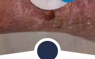 ulcers