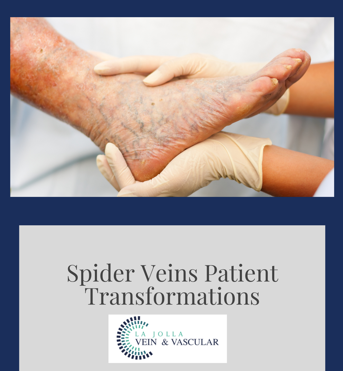 spider vein