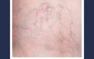 spider veins