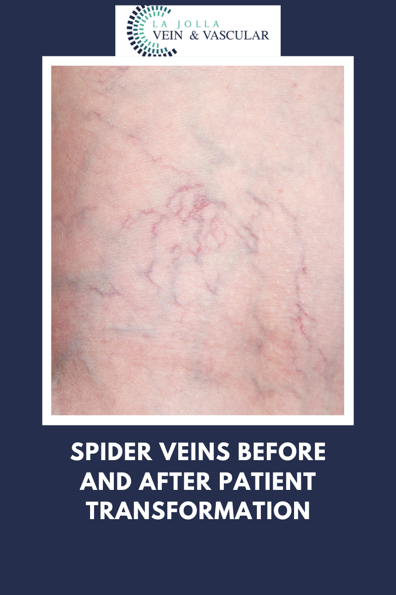 spider veins