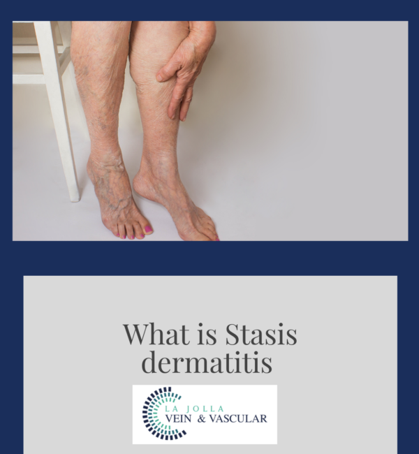 Vein & Vascular Treatment Dermatitis