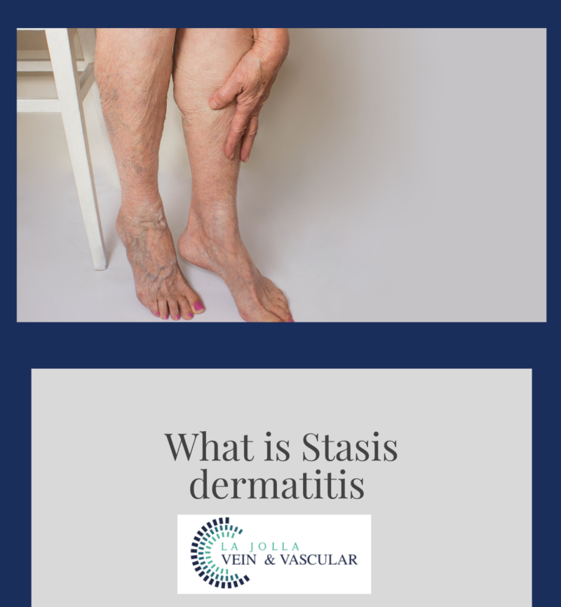 Vein And Vascular Treatment Dermatitis