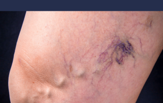 varicose veins