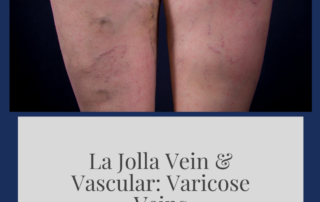 varicose veins