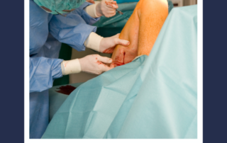 sclerotherapy
