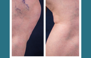 radiofrequency