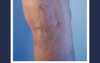 sclerotherapy