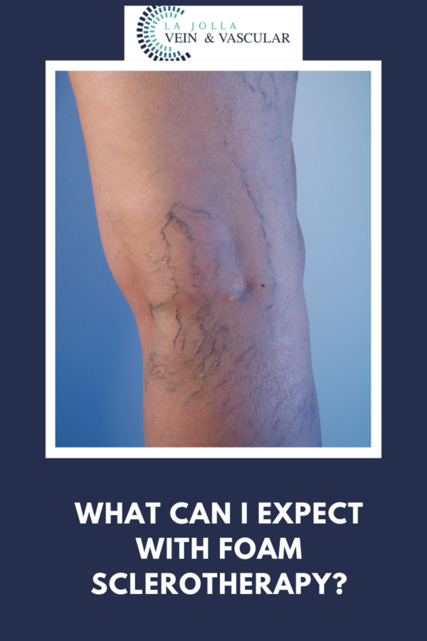Sclerotherapy
