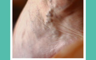 varicose