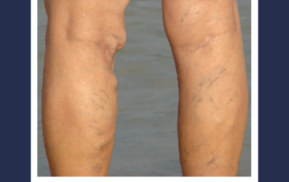 vein