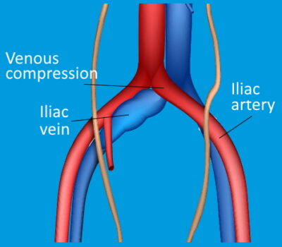 May-Thurner Syndrome Diagnosis & Treatment in San Diego, CA