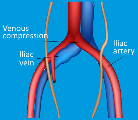 Graphic Iliac vein