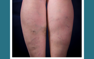 venous
