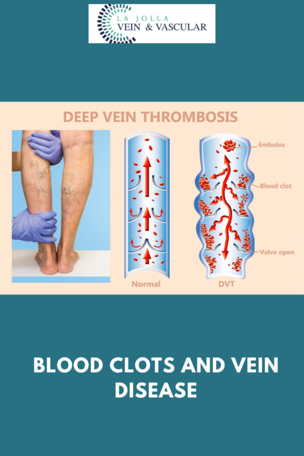 Vein & Vascular Treatment Vein and Vascular Care Clinic La Jolla, CA