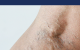 sclerotherapy