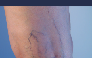 sclerotherapy