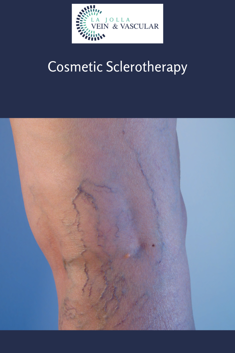 Sclerotherapy for Varicose Veins - Vein & Endovascular Medical Care