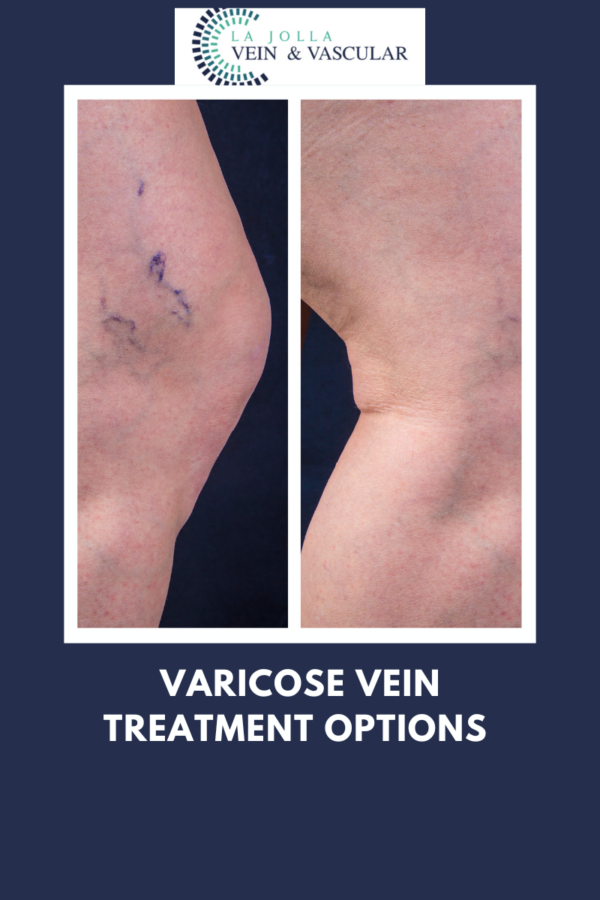 Vein And Vascular Treatment Vein And Vascular Care Clinic La Jolla Ca 