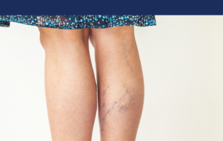 varicose veins