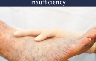 venous insufficiency