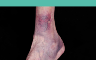 DVT