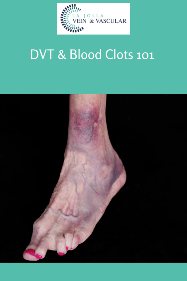 Vein & Vascular Treatment DVT & Blood Clots