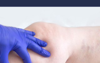 varicose vein treatment