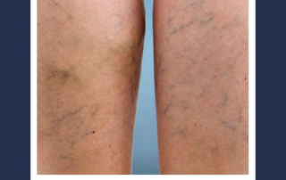 Spider vein treatment