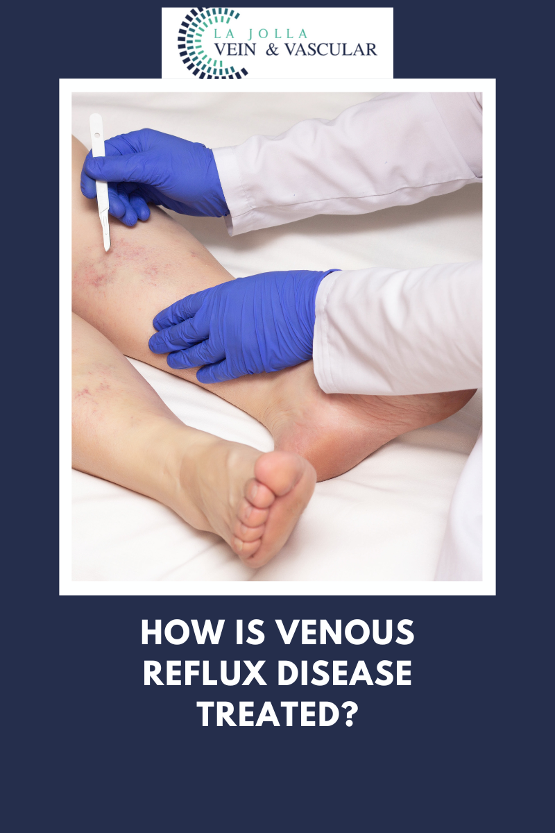 venous reflux