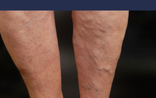 varicose veins