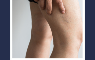 spider veins