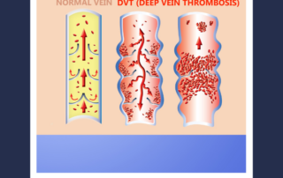 blood clot