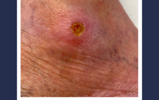 ulcers