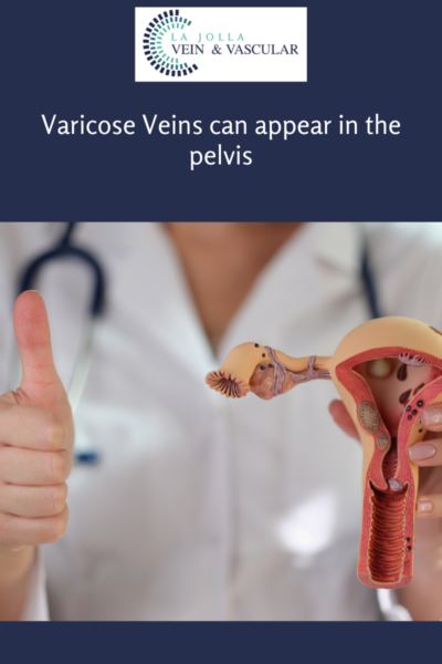 Vein & Vascular Treatment | Pelvic Varicose Veins