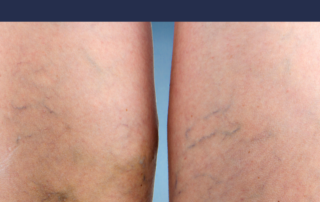 varicose vein treatment