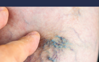 varicose vein treatment