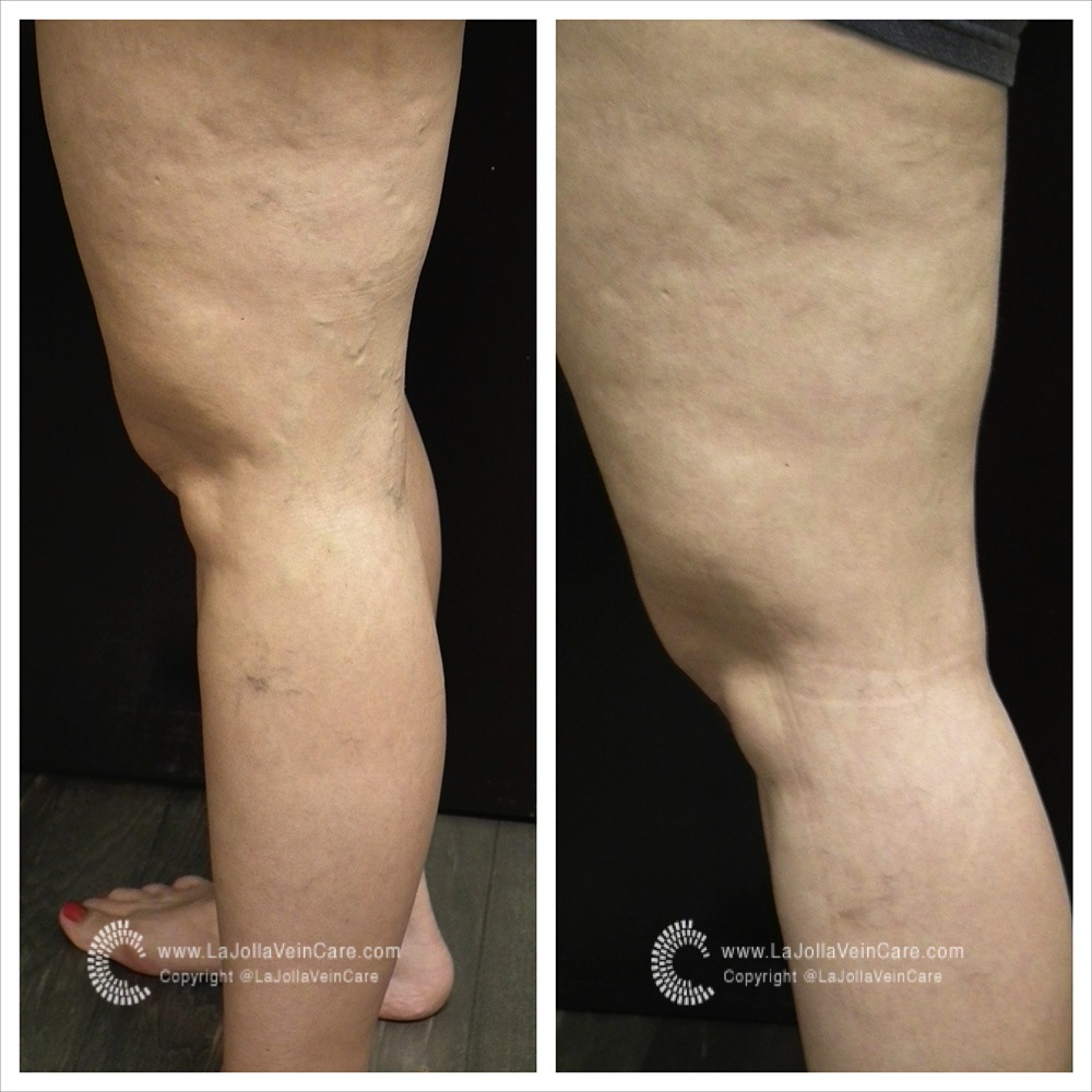 Varicose Vein Treatment Before And After