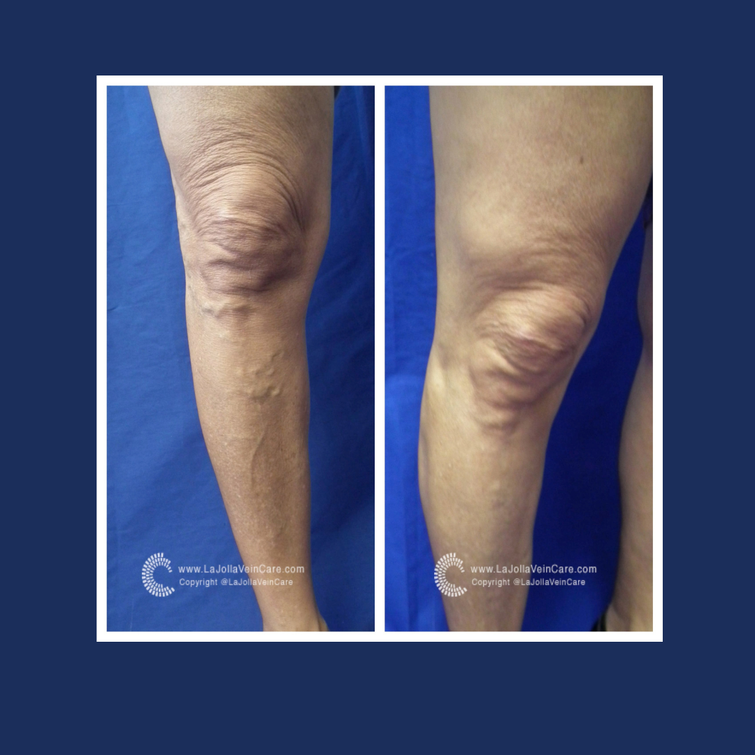 Varicose Vein Vitality