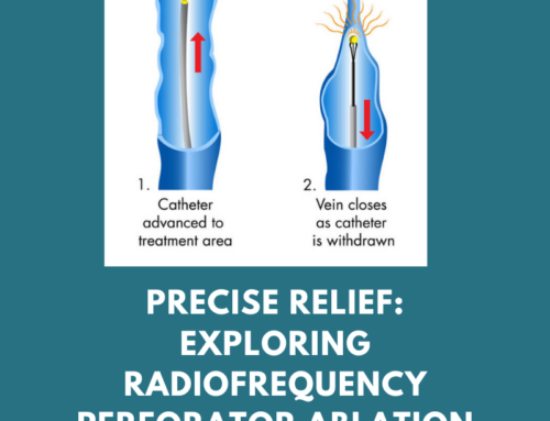 Precise Relief: Exploring Radiofrequency Perforator Ablation for vascular wellness