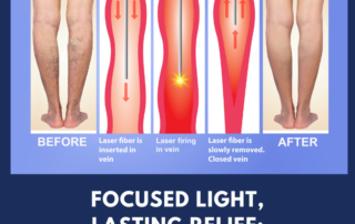 laser